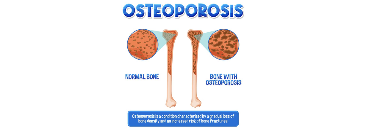 Building Strong Foundations: Understanding and Preventing Osteoporosis